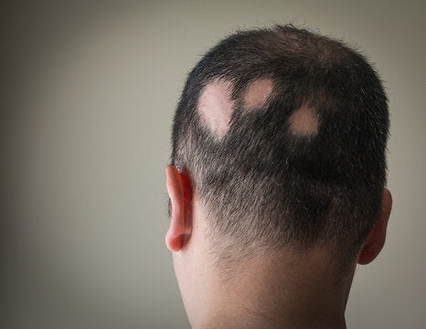 The Best Ways to Treat Alopecia with UV Light