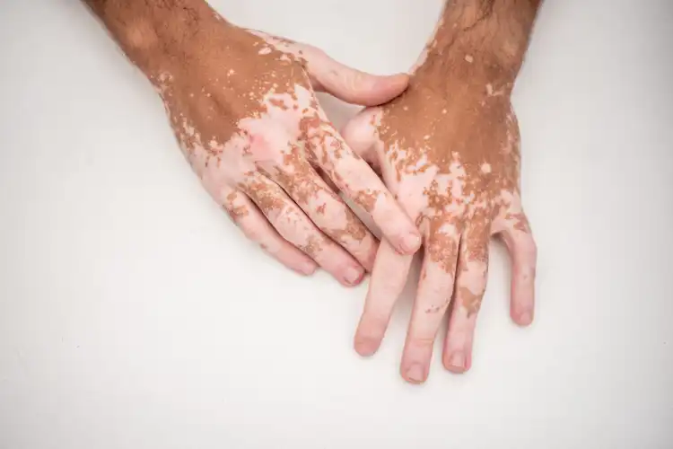 Understanding UV Therapy: Facts and Benefits for Vitaligo Treatment
